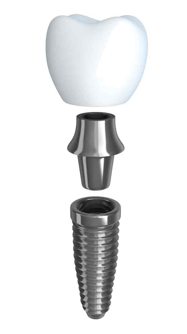 Dental Implant parts