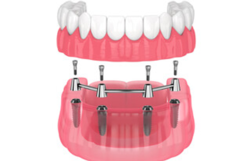 implant supported dentures