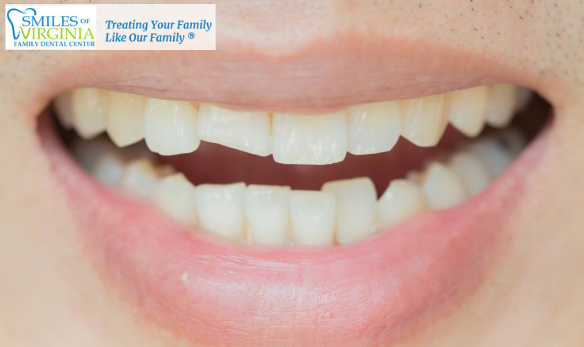 Cracked Or Chipped Teeth