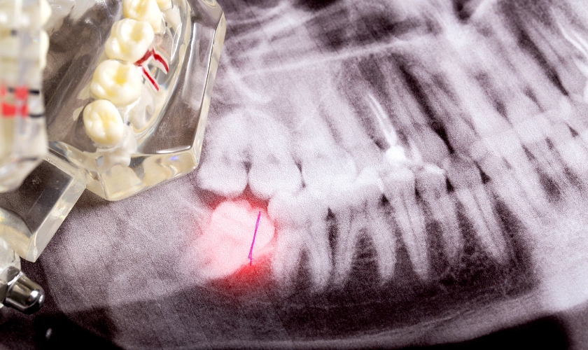 Image of a dentist examining a patient's wisdom teeth in Winchester, VA.