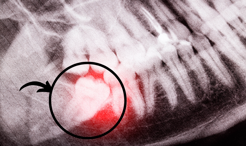 Wisdom Tooth Extraction