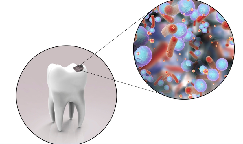A graphic depicting the unveiling of information about cavities and tooth decay, aimed at educating individuals about prevention, treatment, and management of dental issues.