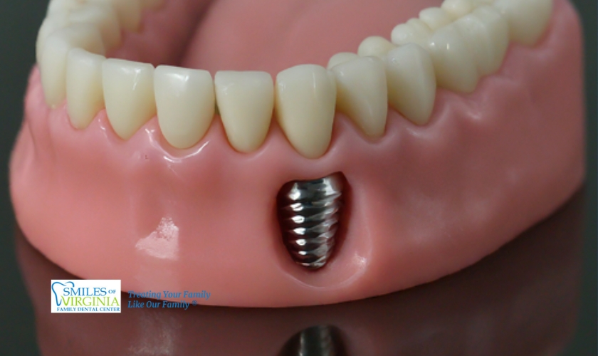Exploring Alternative Options to Dental Implants for Tooth Replacement