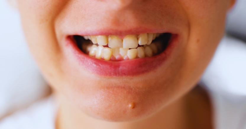 crooked teeth here is how cosmetic dentistry can help